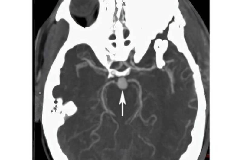 «آنوریسم مغزی» چیست؟/ علائم شایع و ۲ عامل خطر مهم آن
